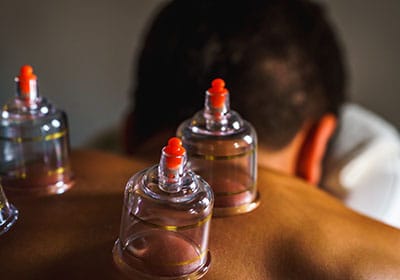 cupping treatment techniques ourchiro brisbane chirapractor and musculoskeletal brisbane