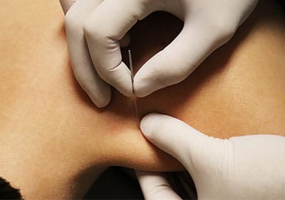 ourchiro dry needling treatment techniques