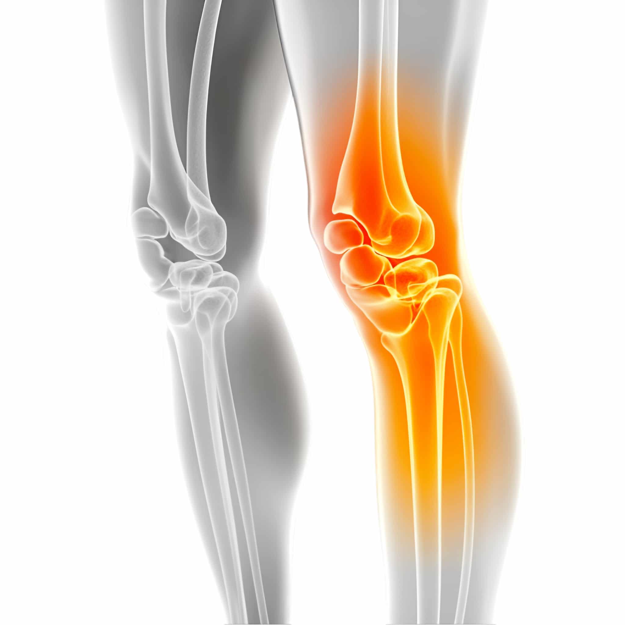 Osteoarthritis Osteoarthritis - Osteoarthritis