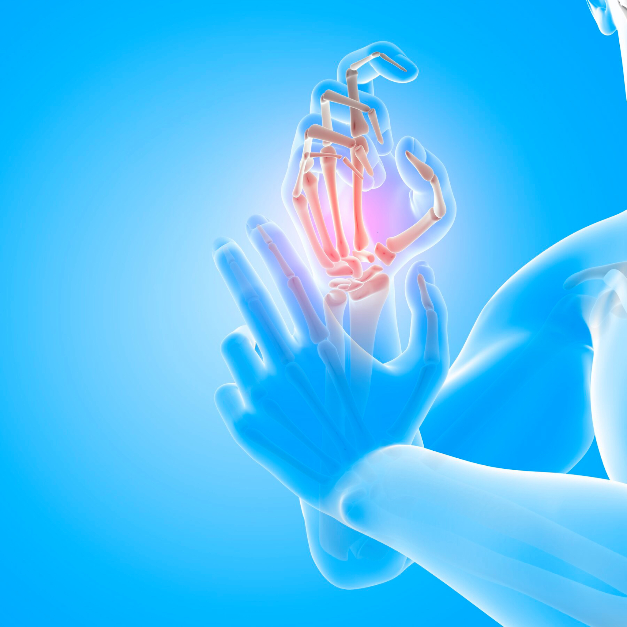 Tendonitis carpal - Tendonitis