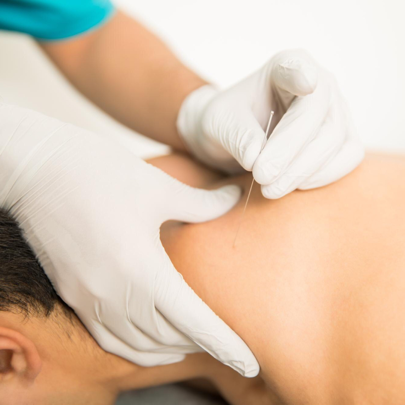 Dry Needling dry needling 2 - Dry Needling