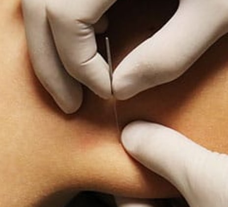 Bottom 1 10 - Dry Needling Therapy