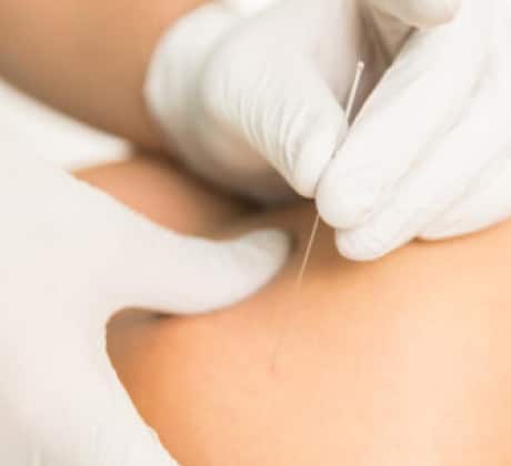 Top 1 10 - Dry Needling Therapy
