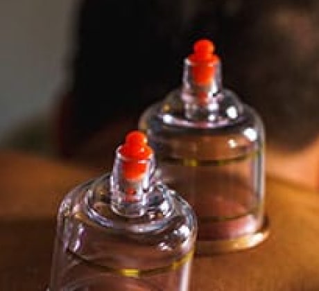 Top 1 11 - Cupping Therapy
