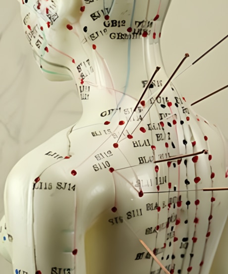 Top 2 10 - Dry Needling Therapy