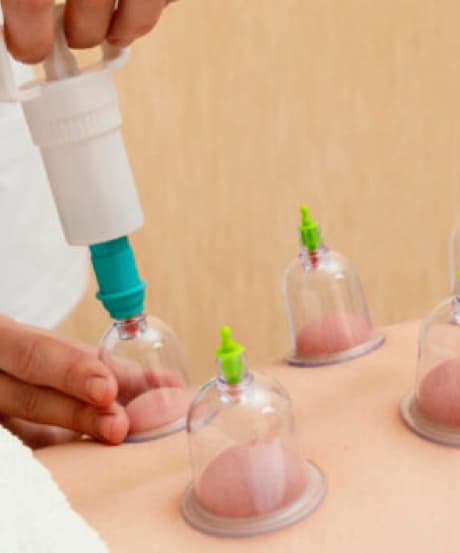Top 2 11 - Cupping Therapy