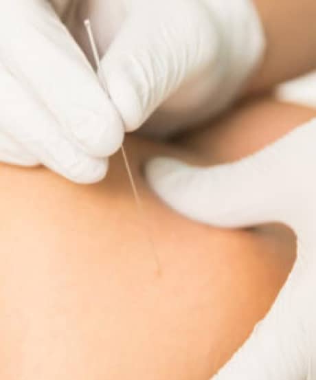 Acupuncture Top 2 - Acupuncture