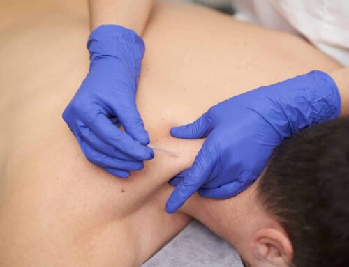 What is dry needling and how does it work  feature 500x383 - What causes your back to &lsquo;lock up&rsquo; or spasm, and how can a chiropractor help?