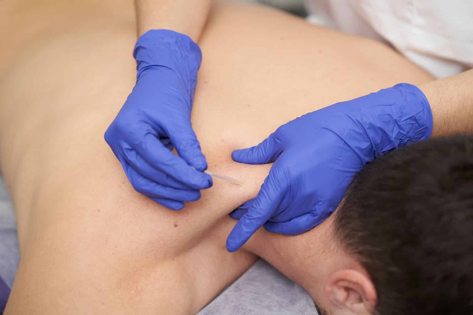 Homepage What is dry needling and how does it work feature - Homepage