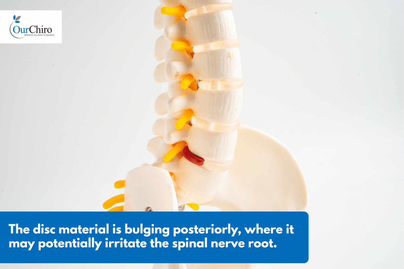 What is a slipped disc, and how can chiropractic help? - Our Chiro