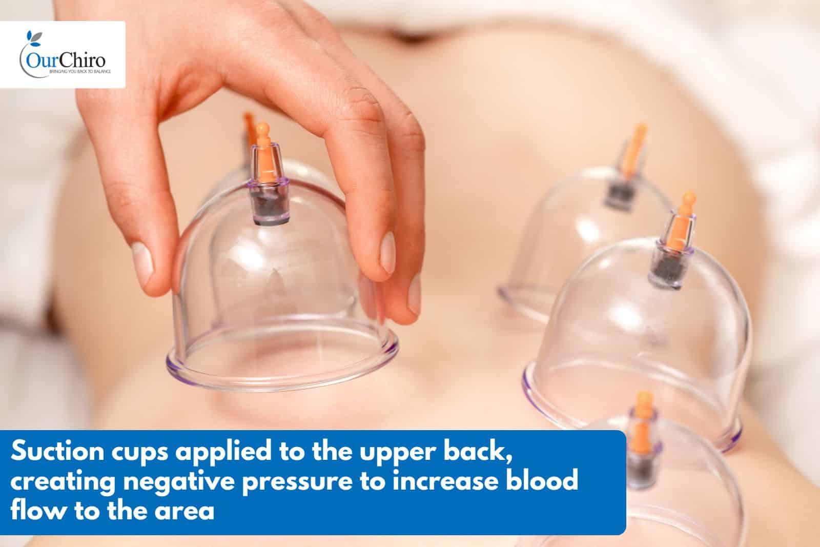 What is cupping therapy? cupping therapy. annotated - What is cupping therapy?
