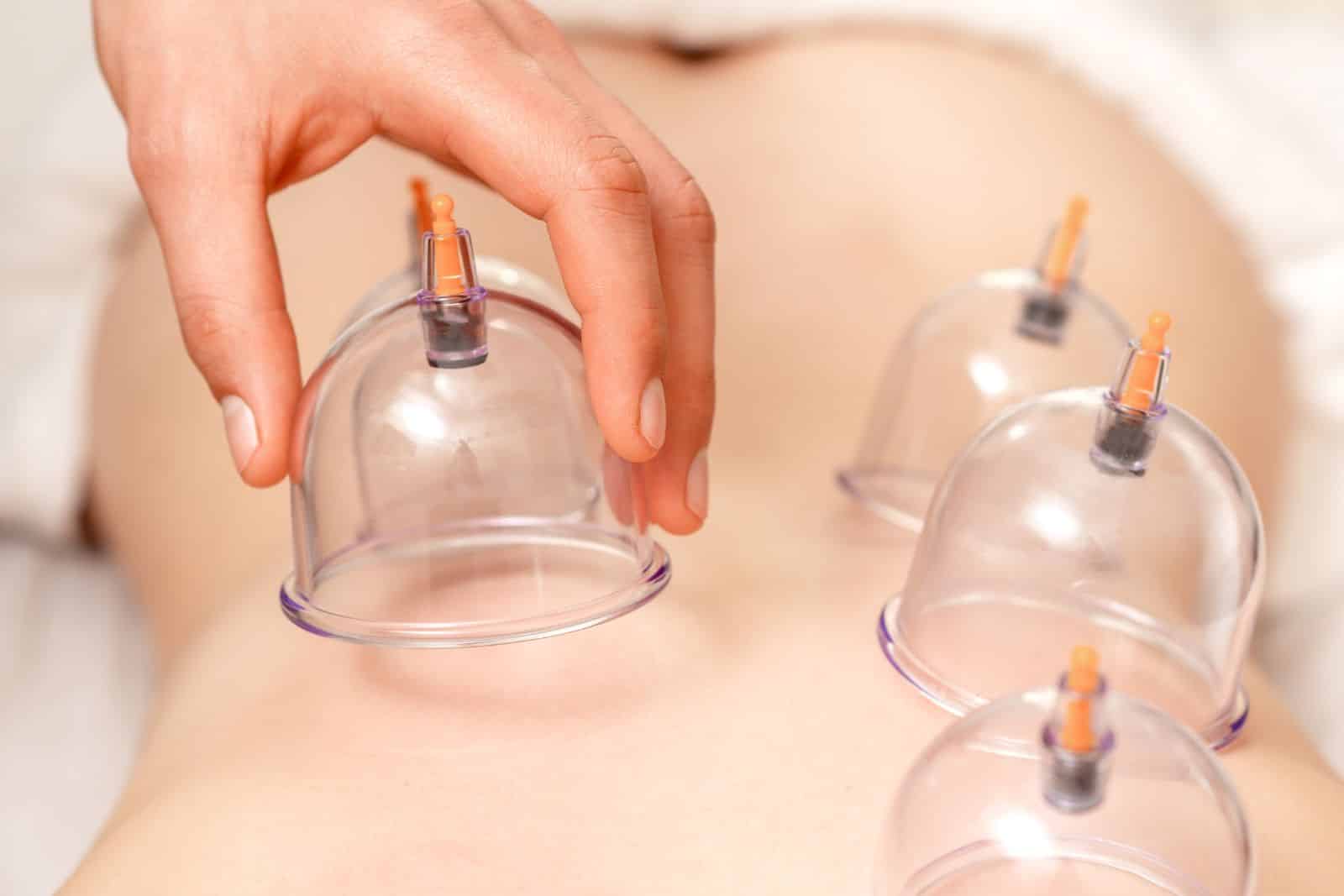 cupping therapy. feature - Homepage